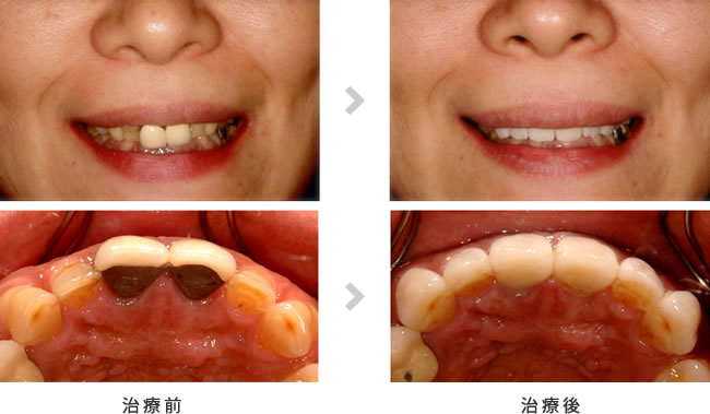 ラミネートベニア施術イメージ2