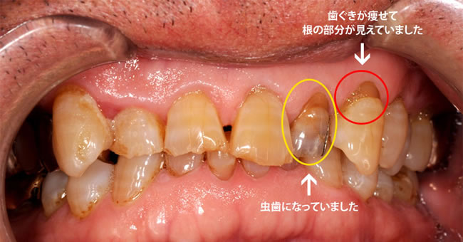 治療前の口腔内は虫歯になった歯と、歯ぐきが痩せて見えた根の部分が目立っていました。