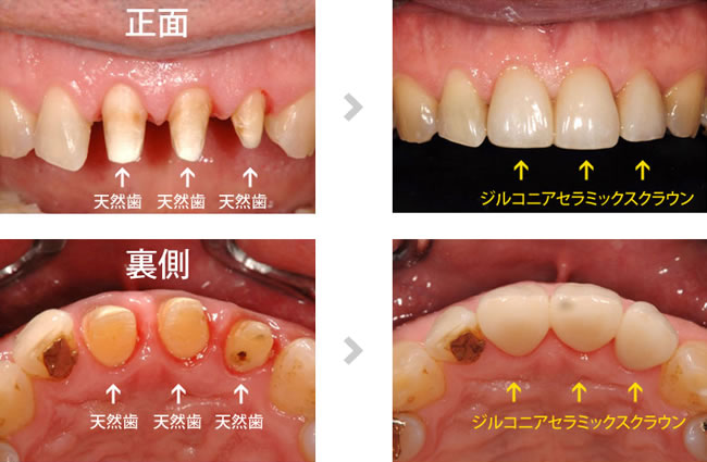 治療前後の歯の表裏