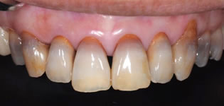特殊な歯の色の症例
