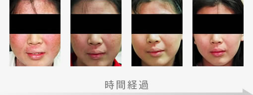 アトピー性皮膚炎の症状改善例5