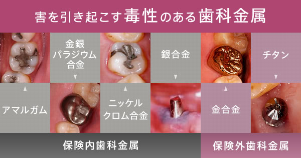 害を引き起こす毒性のある歯科金属「アマルガム」「金銀パラジウム合金」「ニッケルクロム合金」「銀合金」「金合金」「チタン」